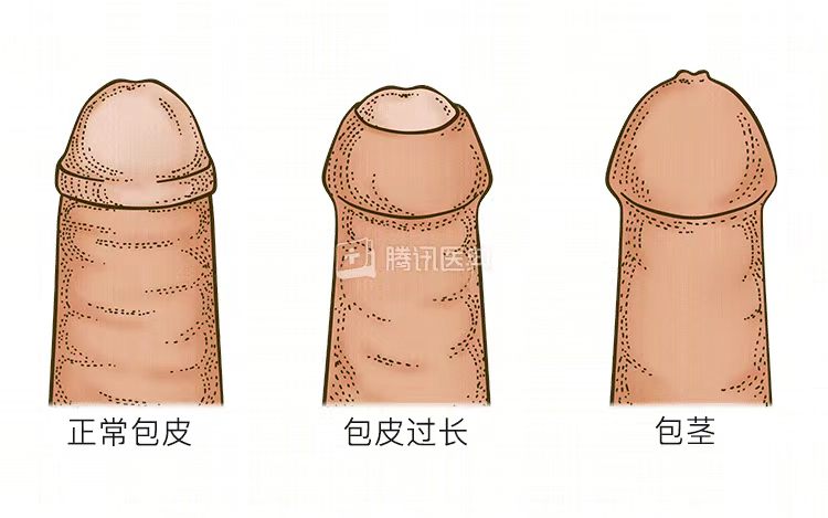 割包皮真的能让时间更持久、更爽,鸡鸡变长吗2 ba83c0b3e8962c2e005403ccf4a37087