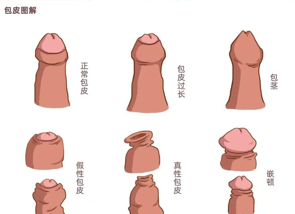 割包皮真的能让时间更持久、更爽,鸡鸡变长吗3 bd425a0ade2fdadfb31333fdab440941